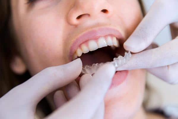 Orthodontic Treatments